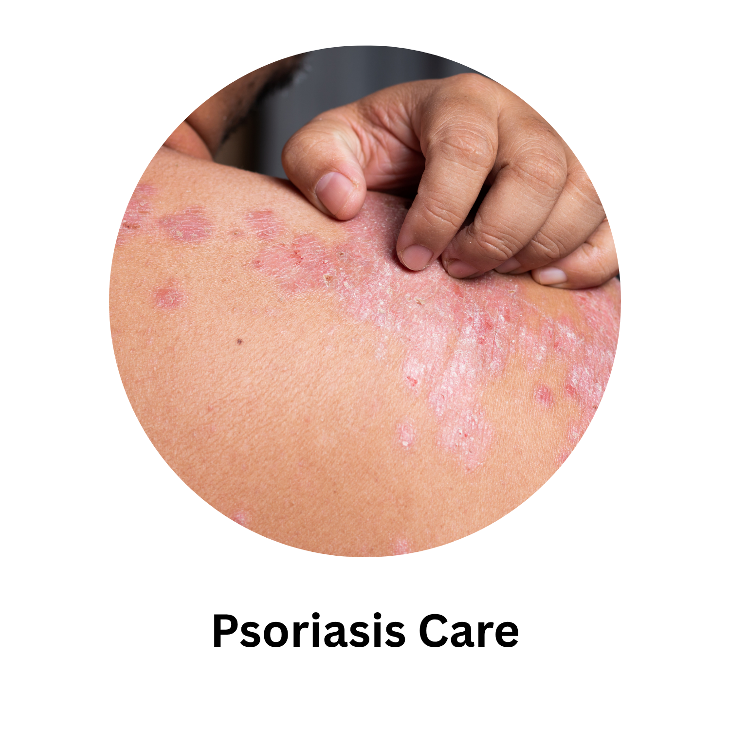 Psoriasis Care