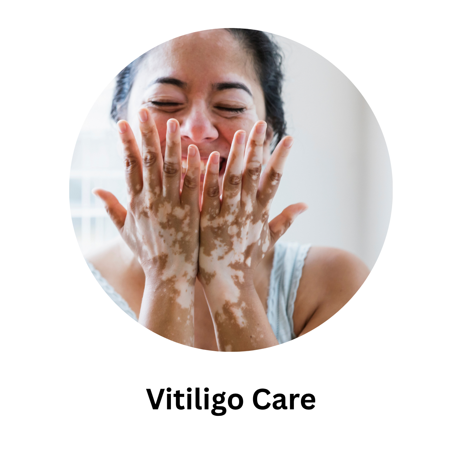 Vitiligo Care