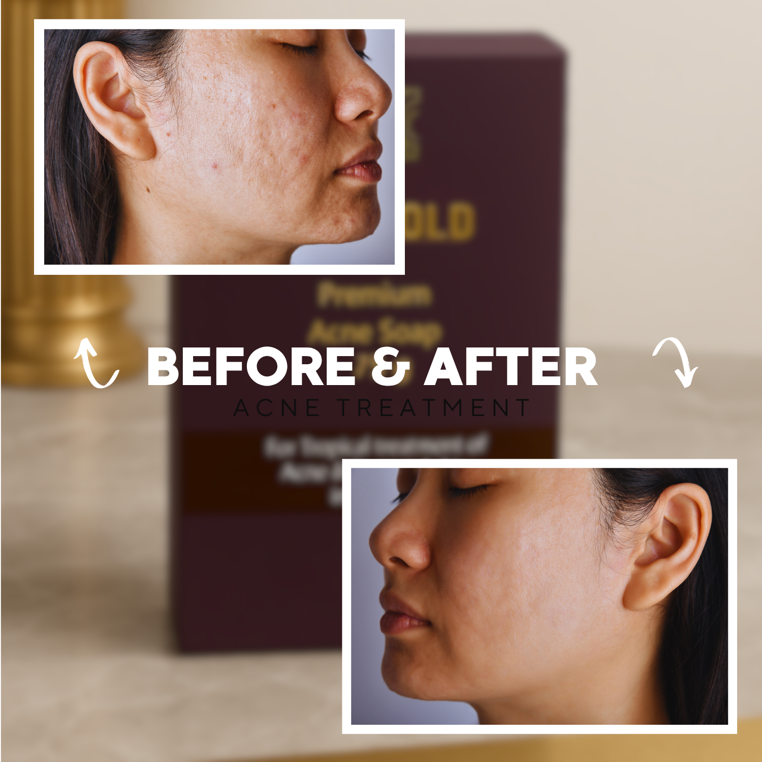 Premium Acne Soap