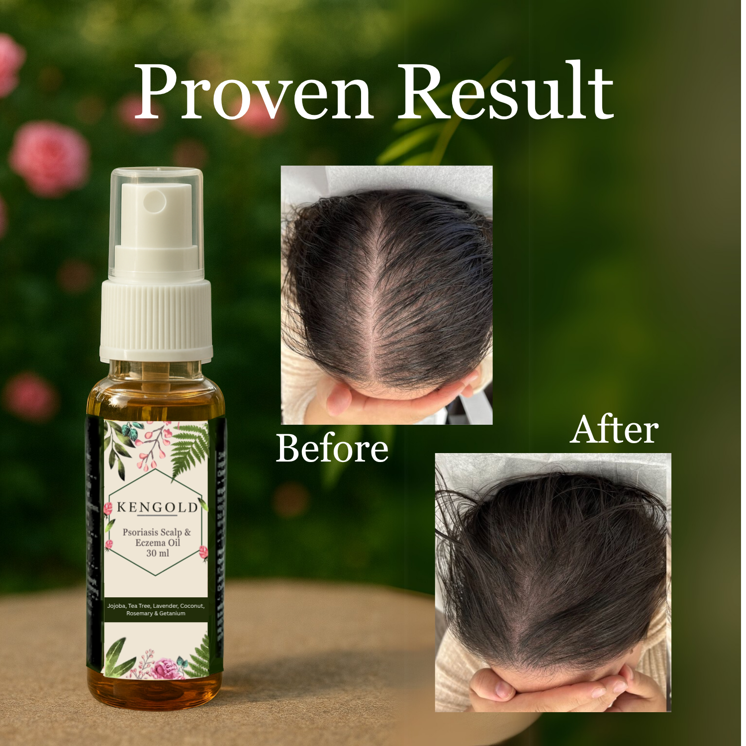 Psoriasis Skin & Hair oil