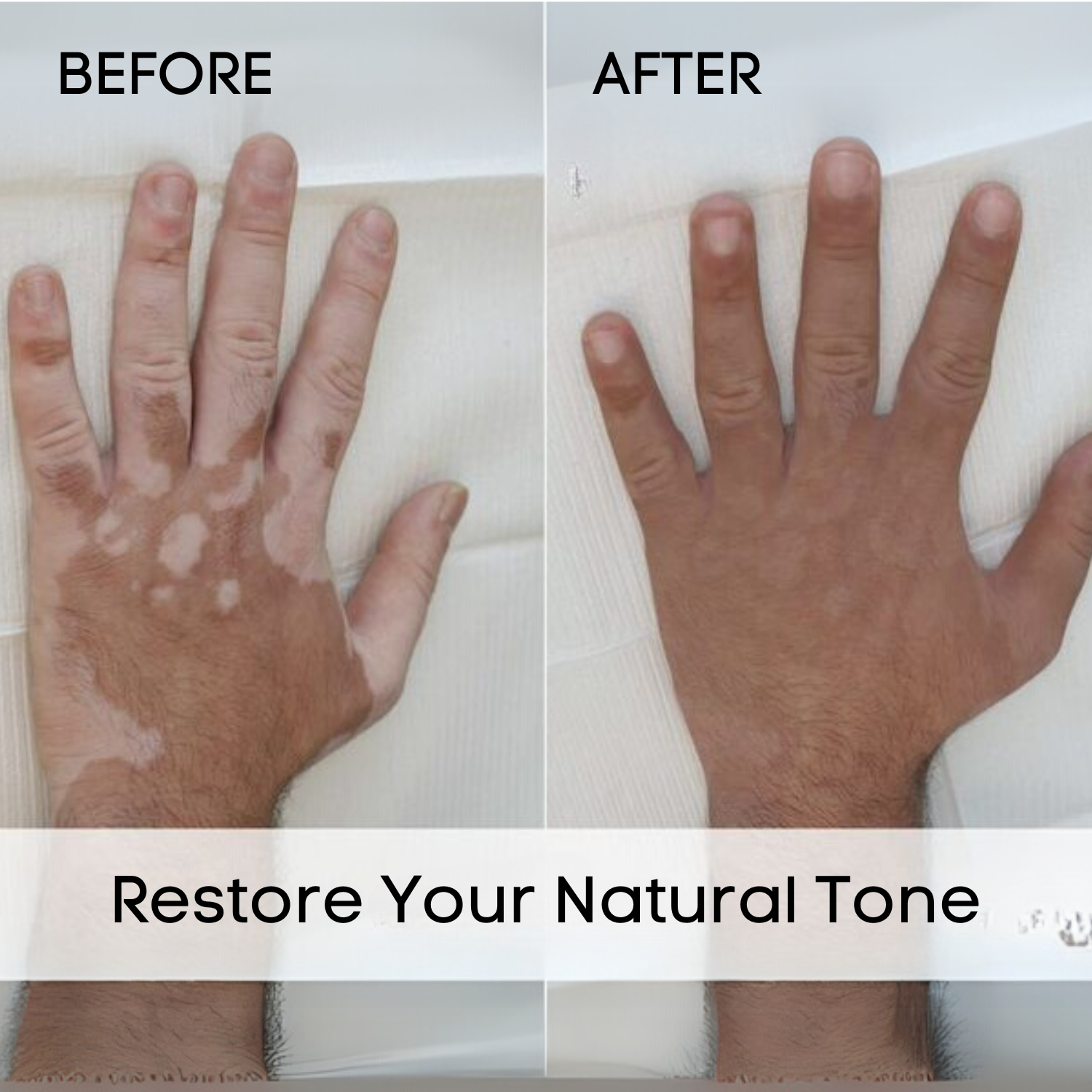 Natural Ayurvedic Vitiligo cream