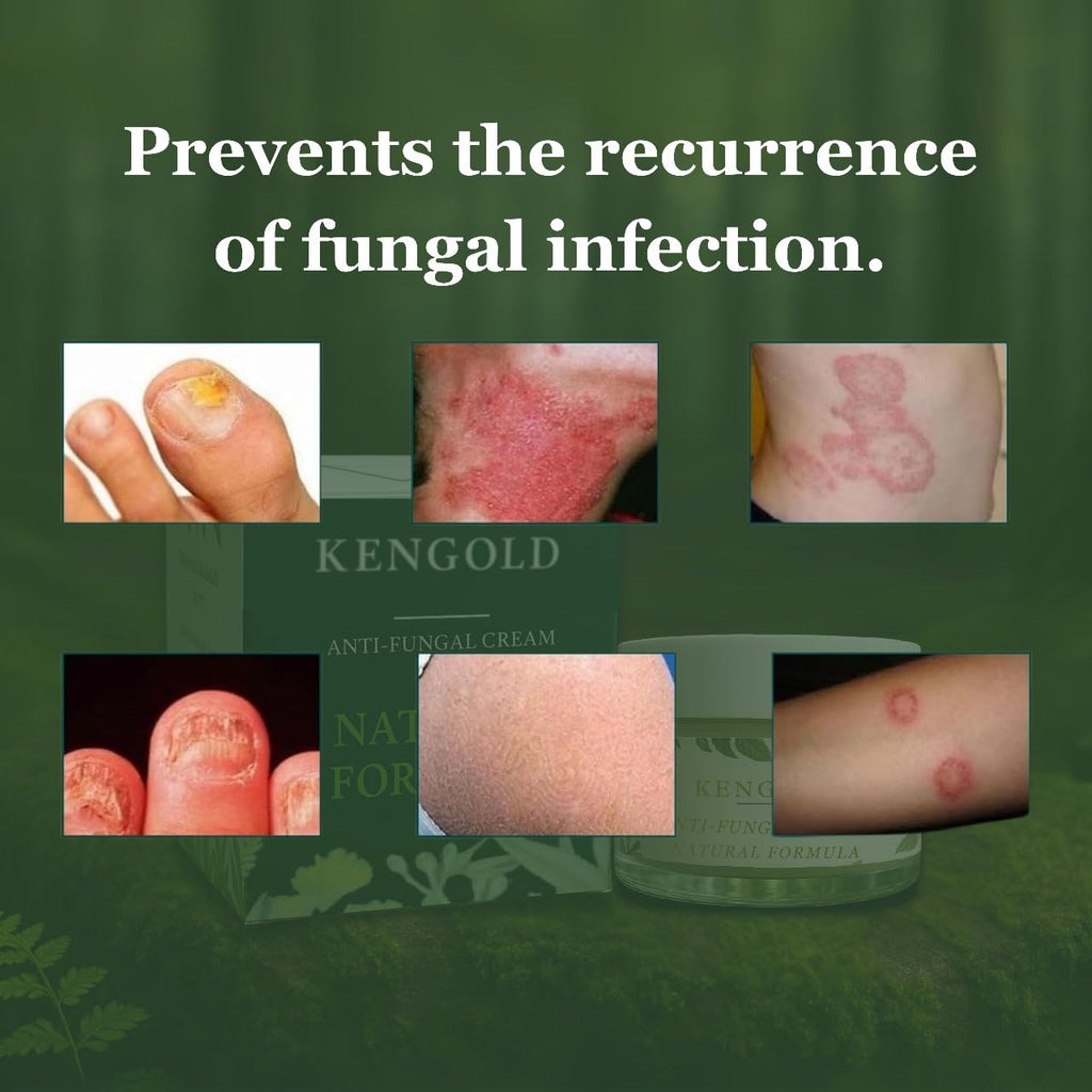 Anti- Fungal Ayurvedic Cream For Men & Women