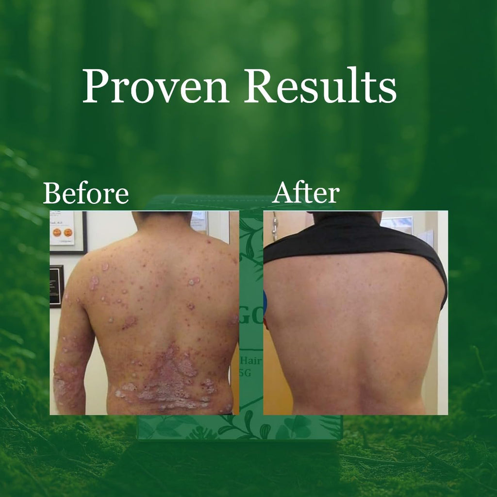 Psoriasis Skin & Hair Soap | Purify Skin | Pain Relief With Natural Ingredients