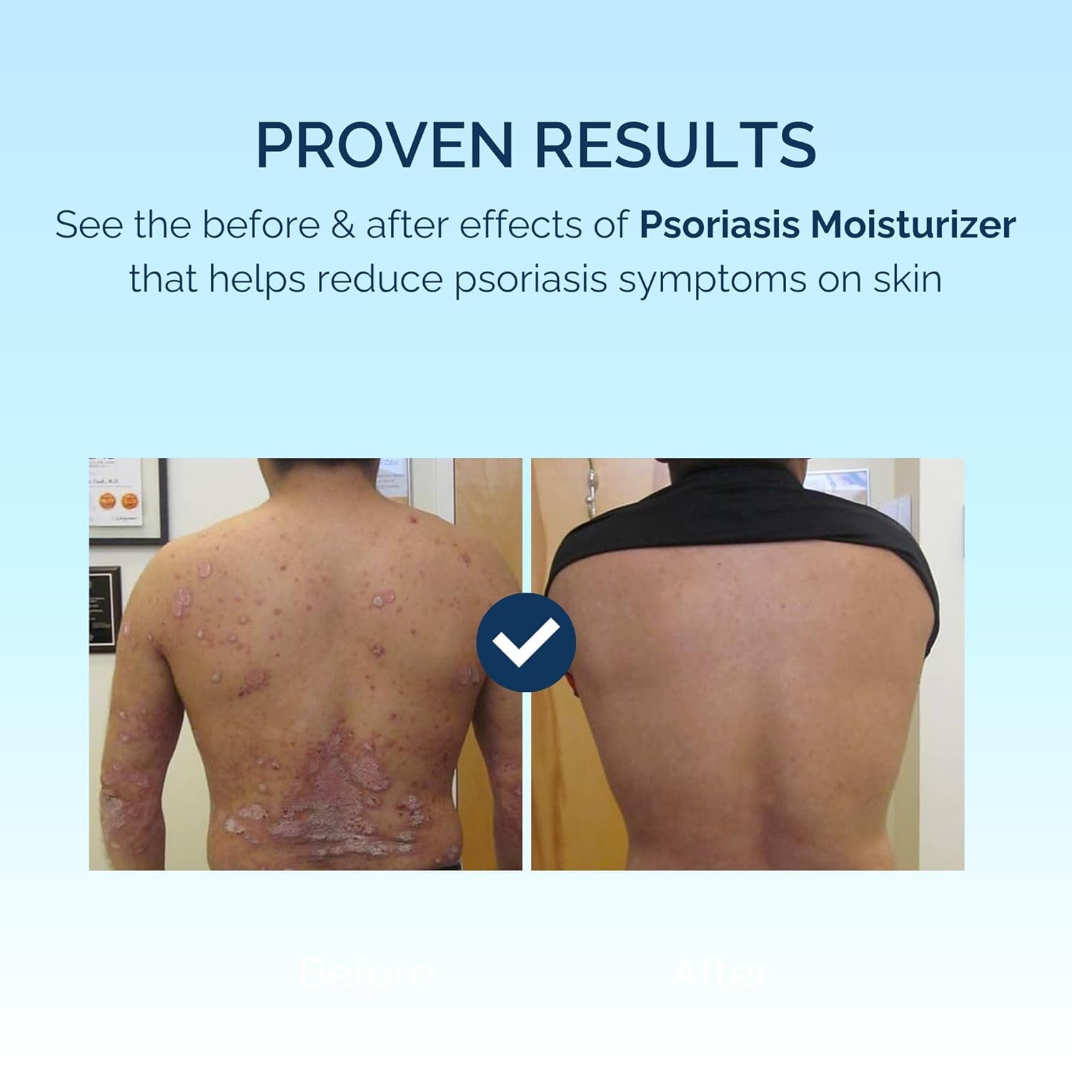 Psoriasis Skin & Hair Soap+Cream |Pain Relief With Natural Ingredients