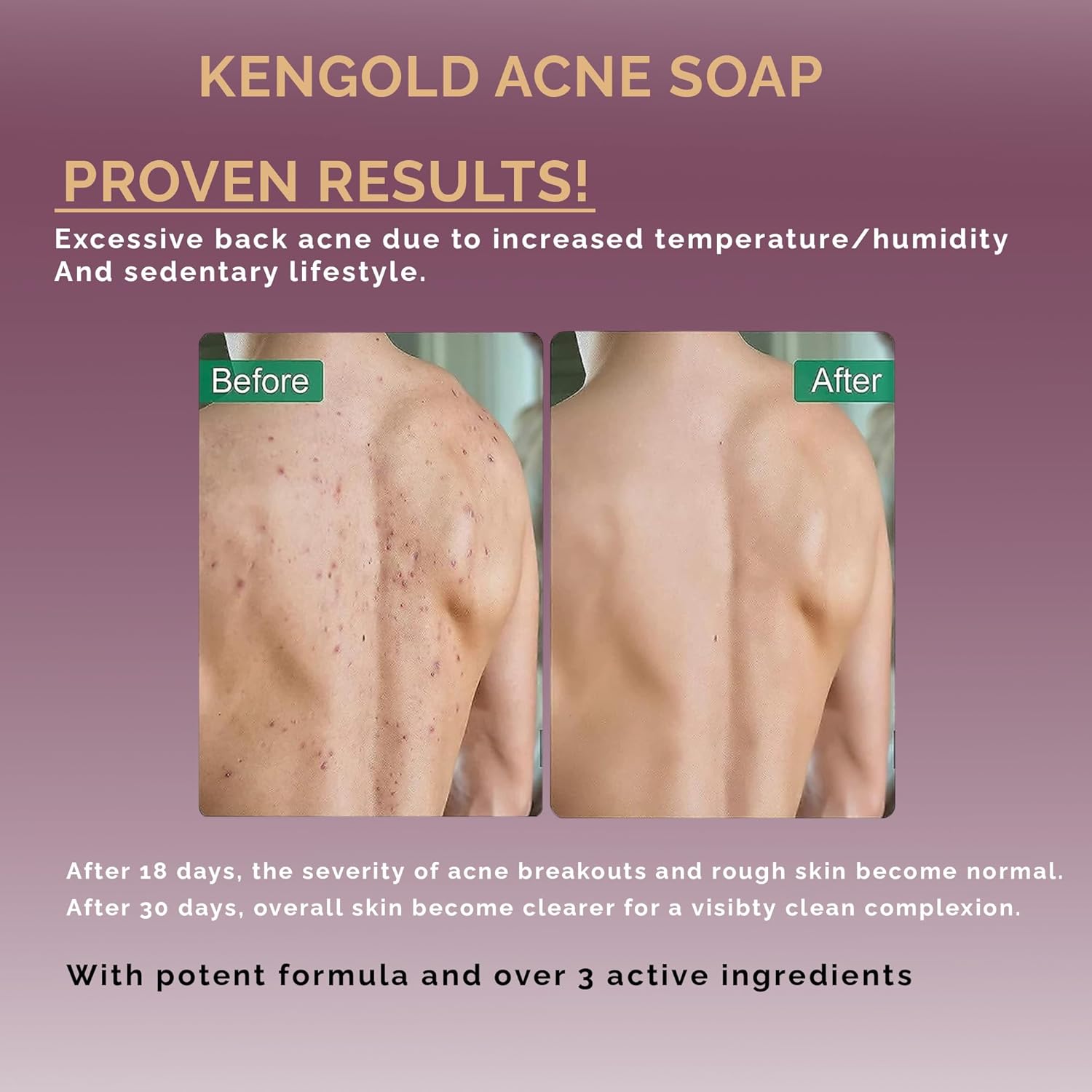 Premium Anti-Acne Soap | Clears & Fades the Acne Prone Skin