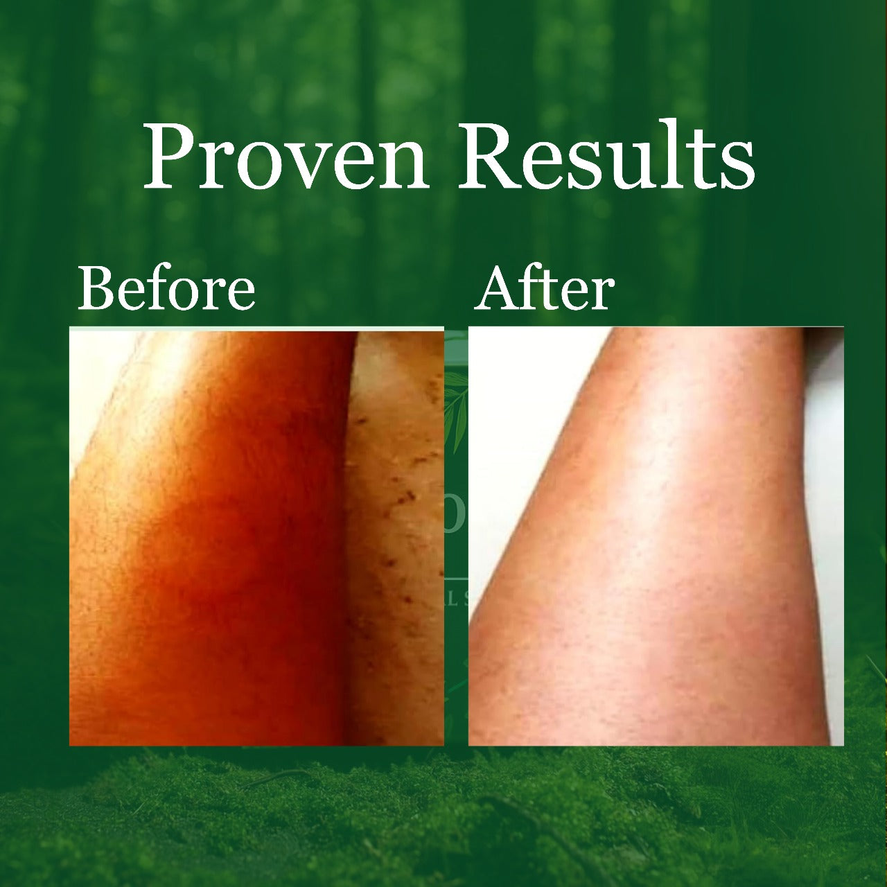 Anti Fungal & Anti Bacterial Soap  & Anti- Fungal Ayurvedic Cream